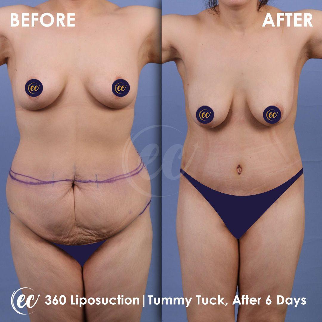 estherian BODY Surgery 5-min