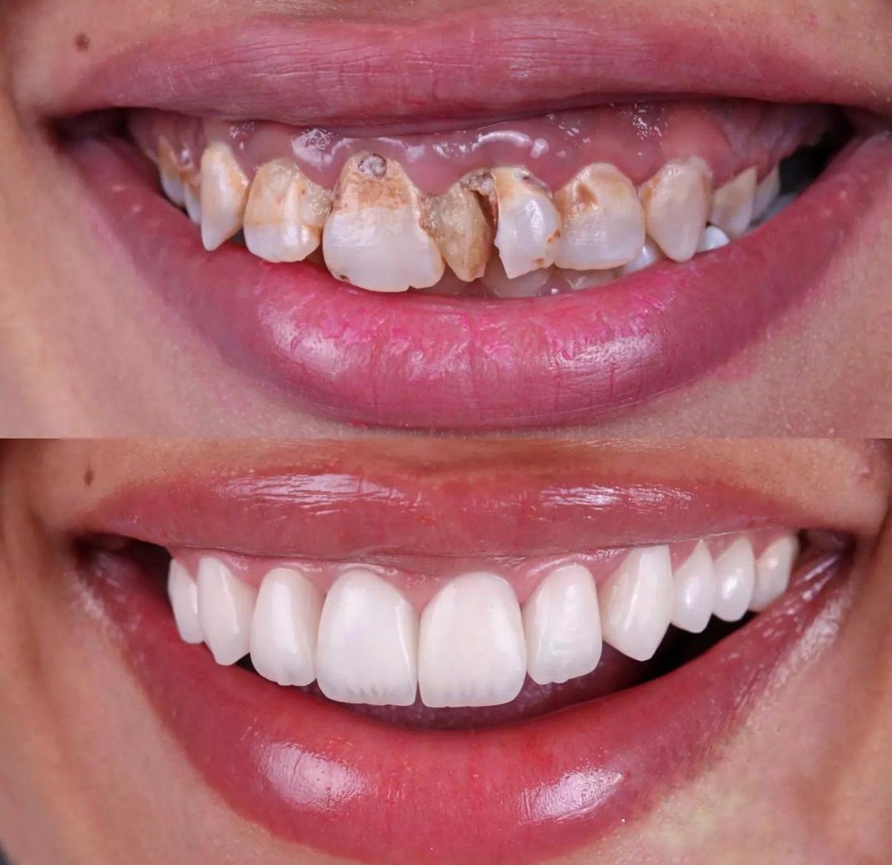 12- Before-after zirkon vaka