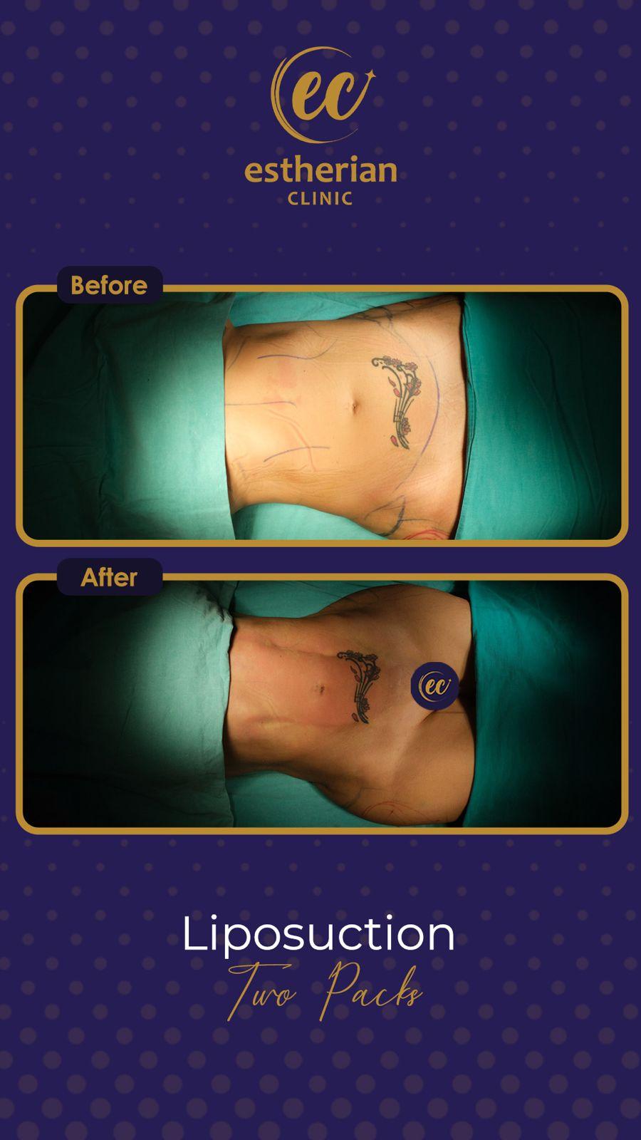 estherian BODY Surgery 12-min