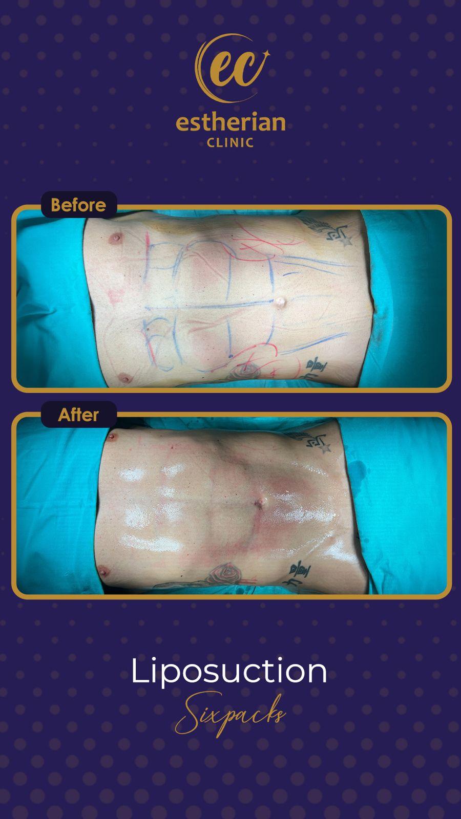 estherian BODY Surgery 15-min