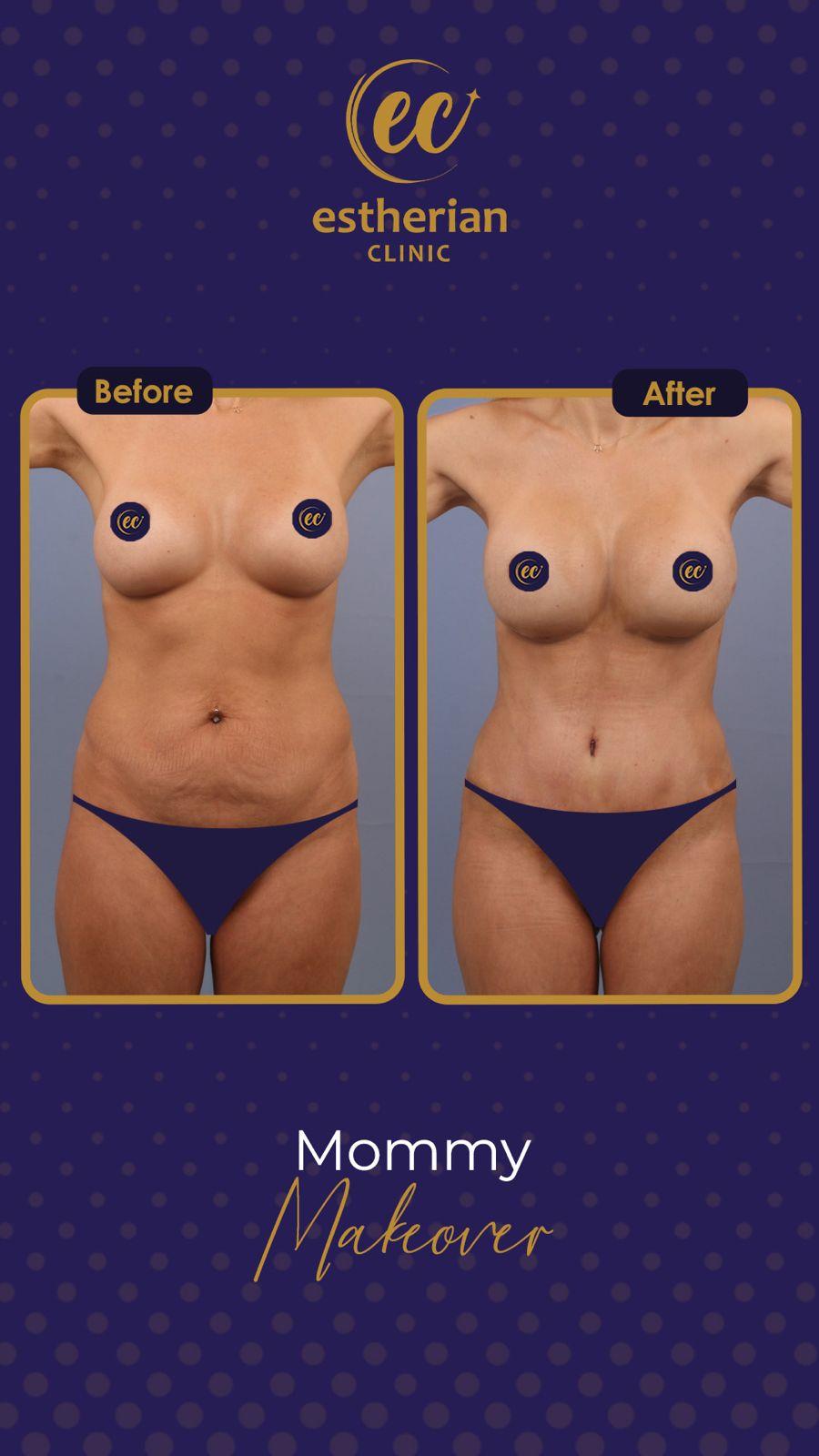 estherian BODY Surgery 16-min