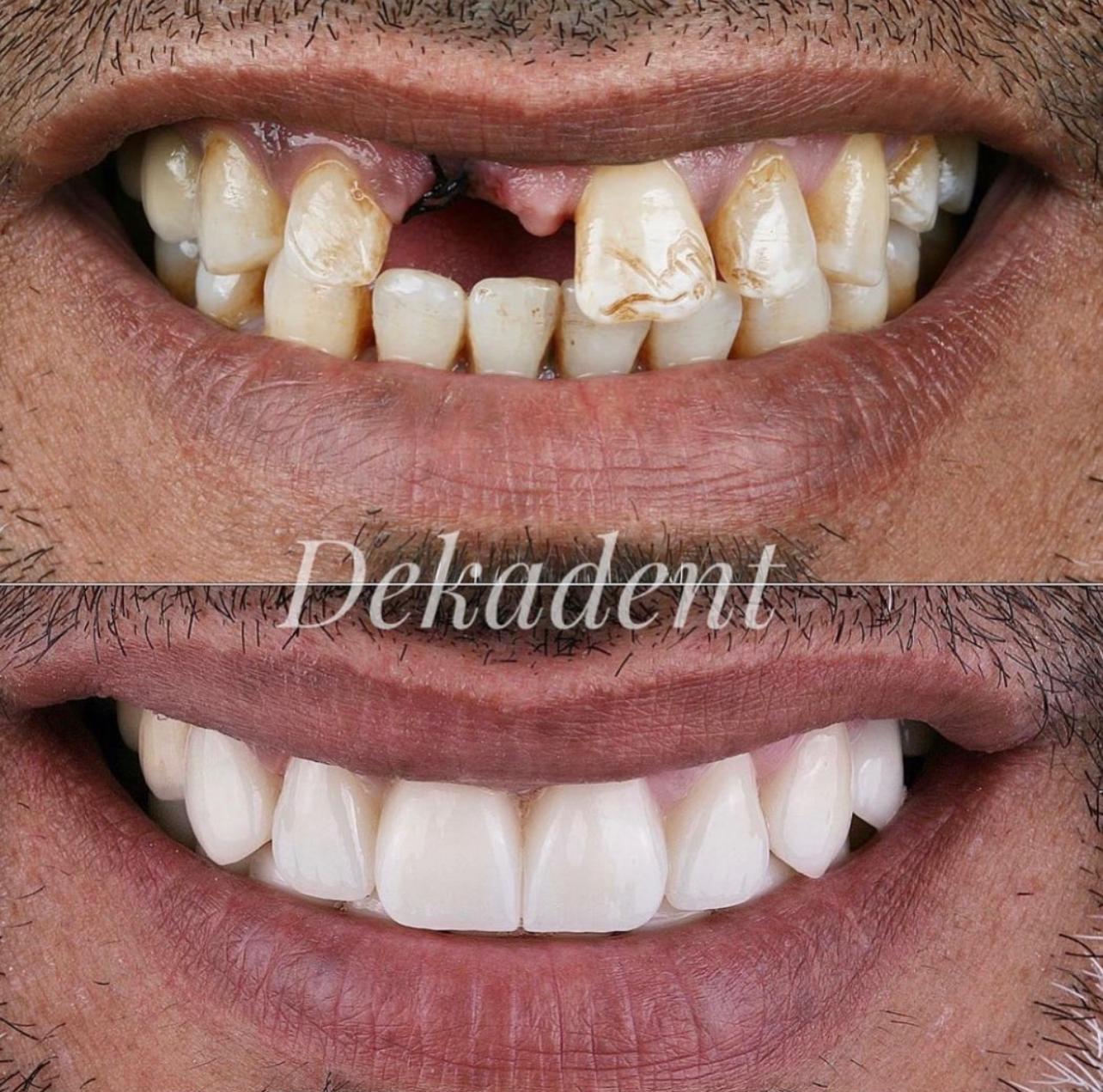 15- Before-after zirkon vaka