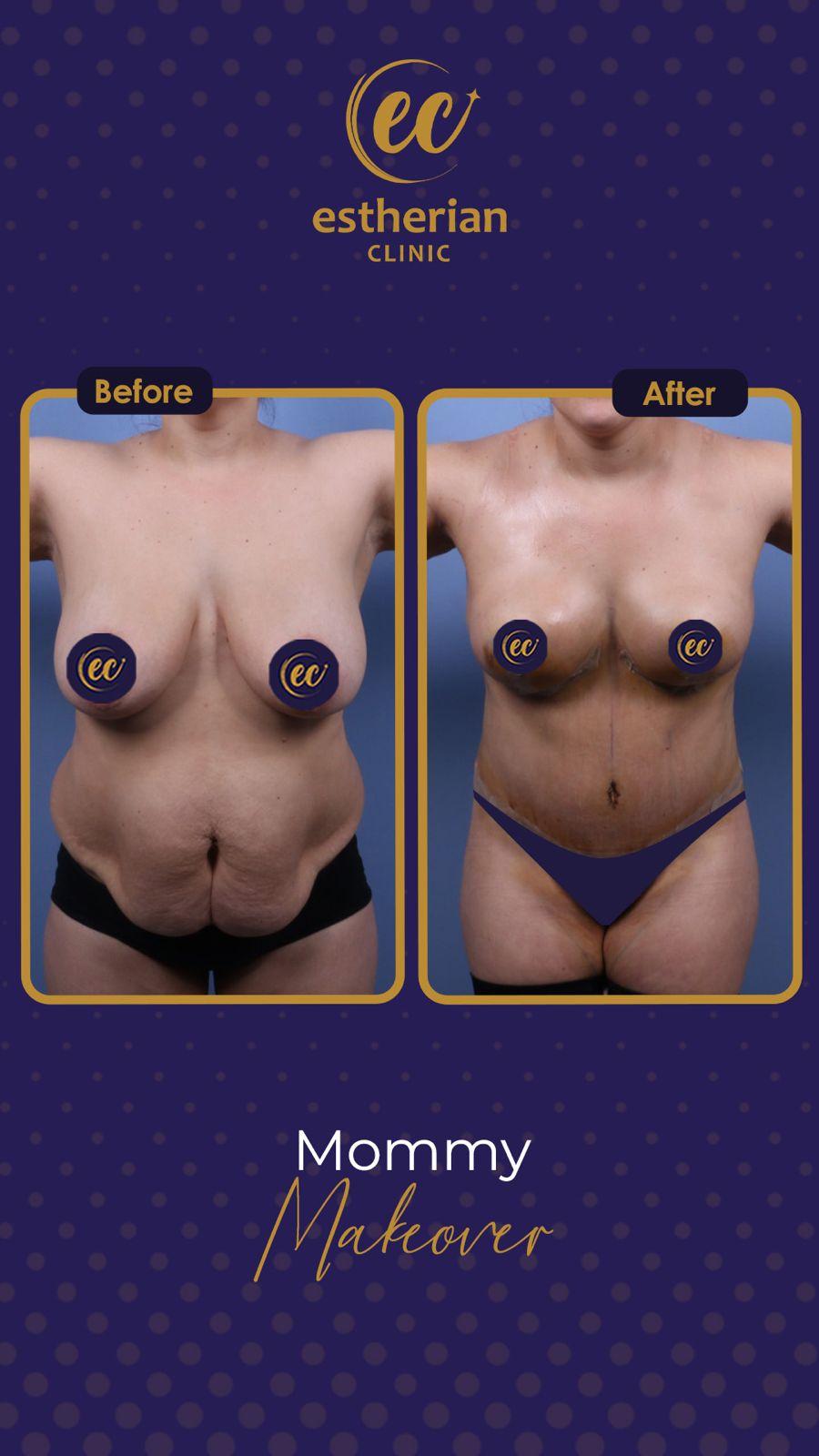 estherian BODY Surgery 13-min
