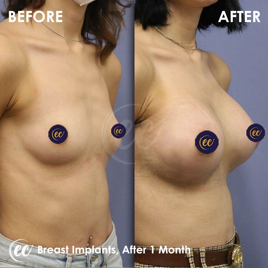 estherian Breast Surgery 4