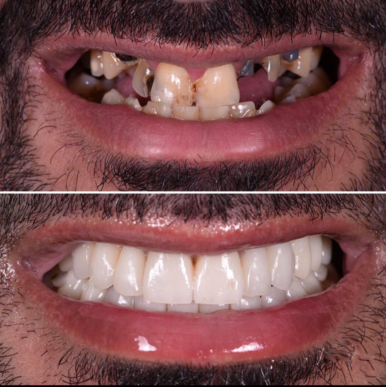 16- Before-after zirkon vaka