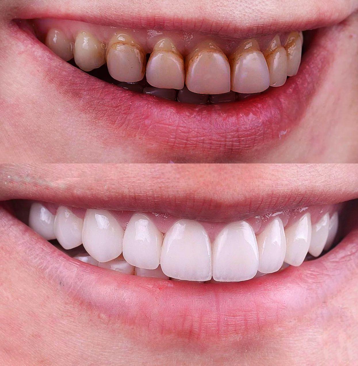 1- Before-after zirkon vakası