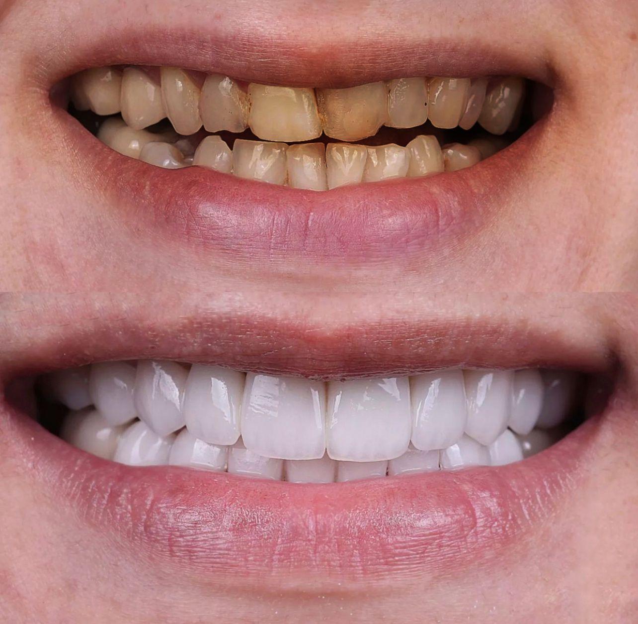 2- Before-after zirkon vaka