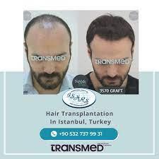 Transmed Hair Clinic result