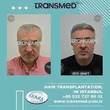 Transmed Hair Clinic result