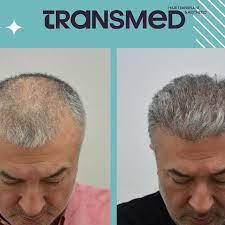 Transmed Hair Clinic result