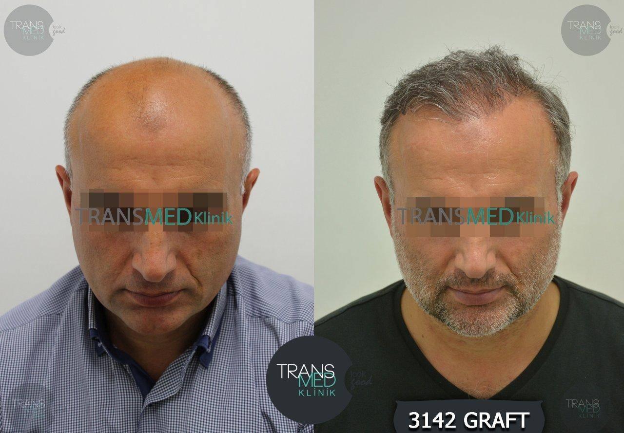 Transmed Hair Clinic result
