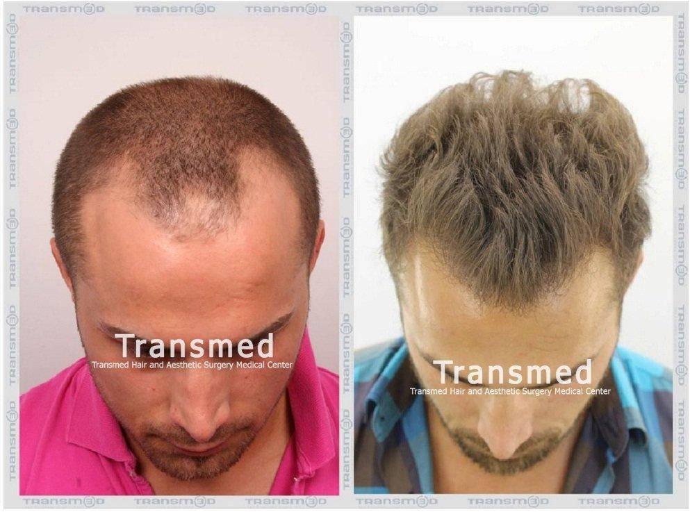Transmed Hair Clinic result