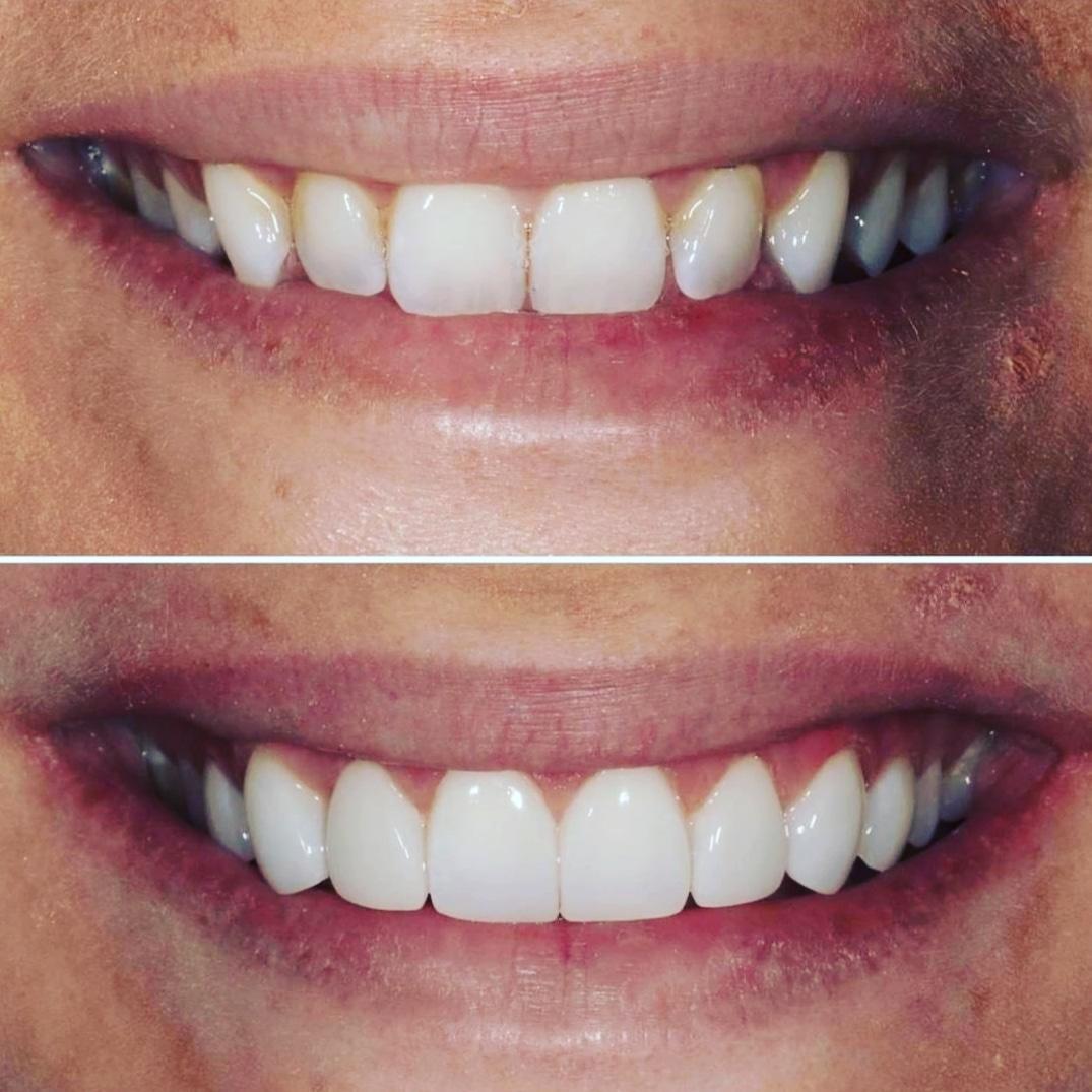 9- Before-after zirkon vaka