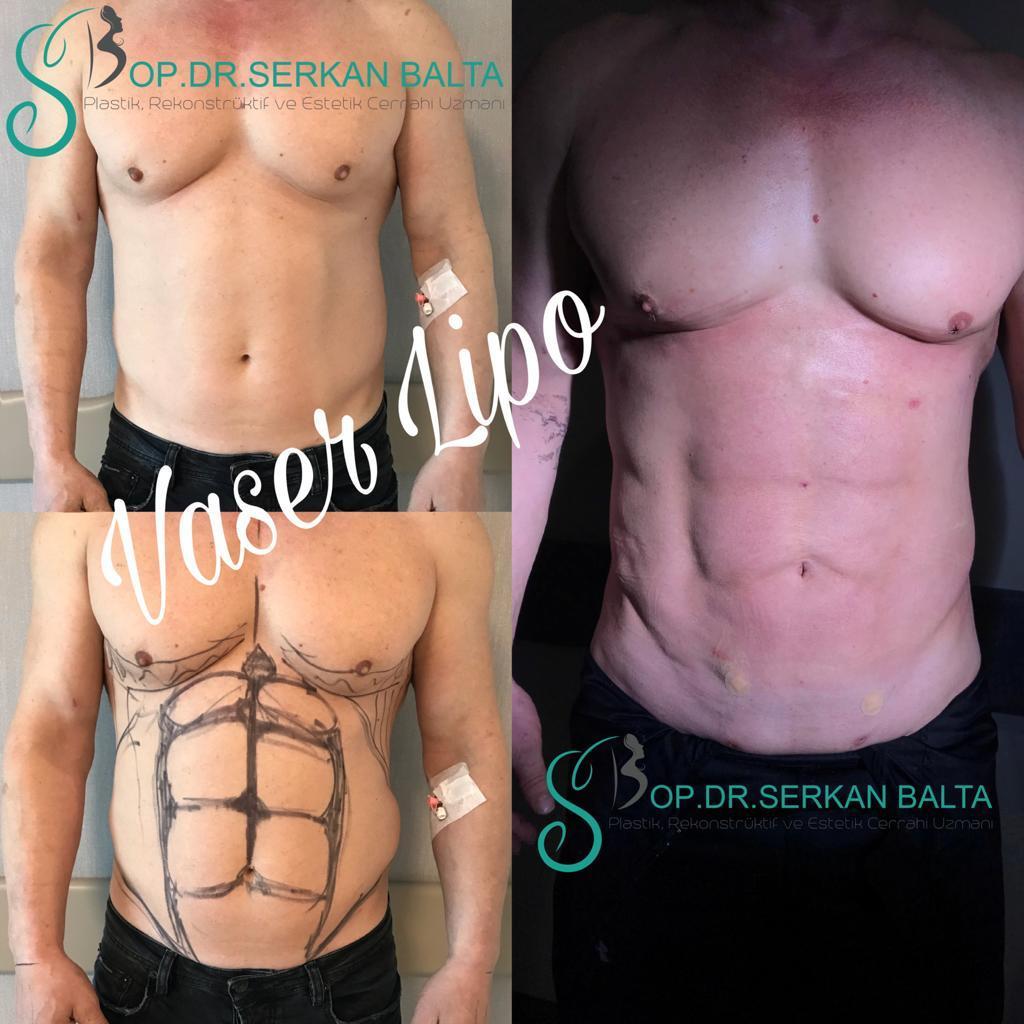 ELIT CLINIC COSMETIC SURGERY RESULTS 1