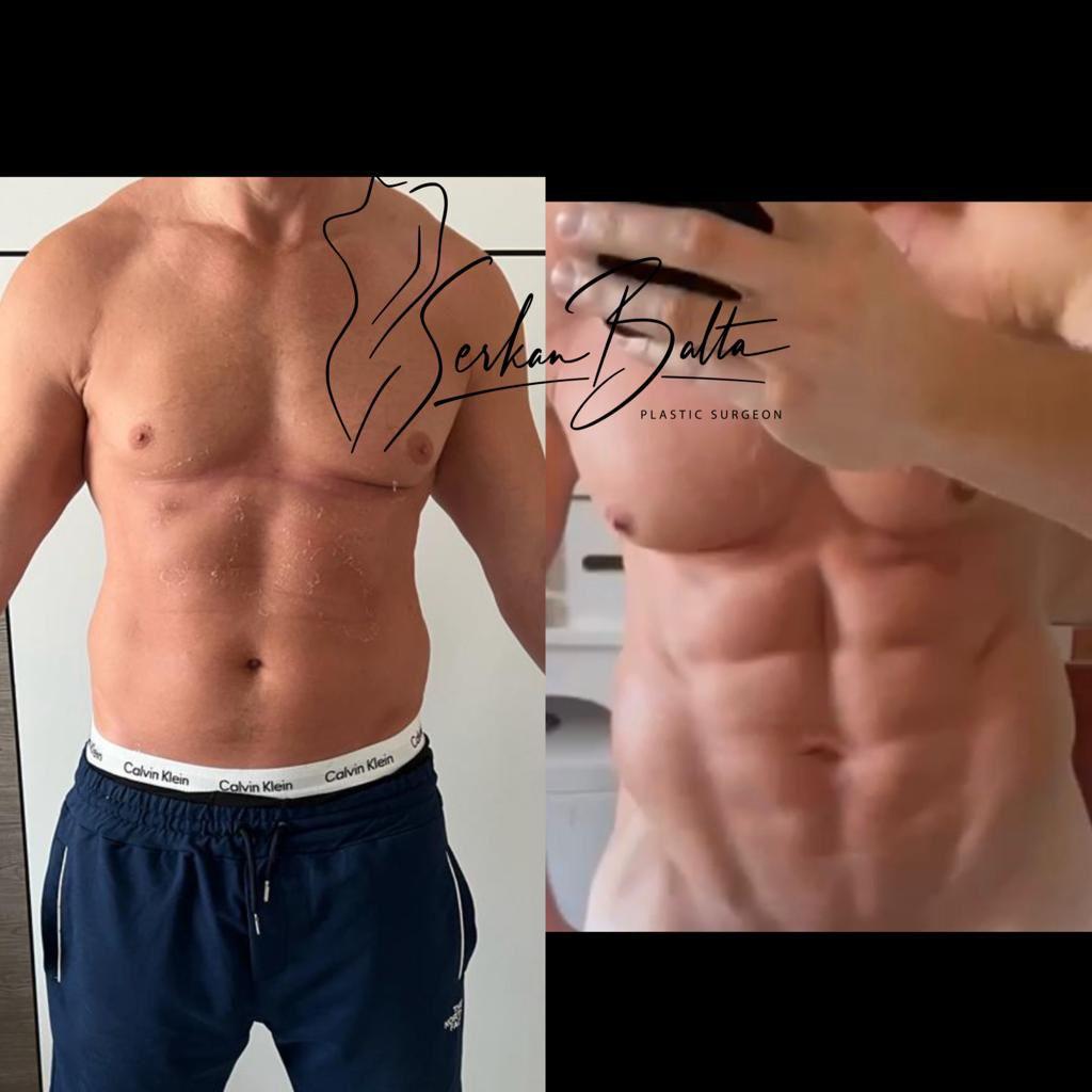 ELIT CLINIC COSMETIC SURGERY RESULTS 7