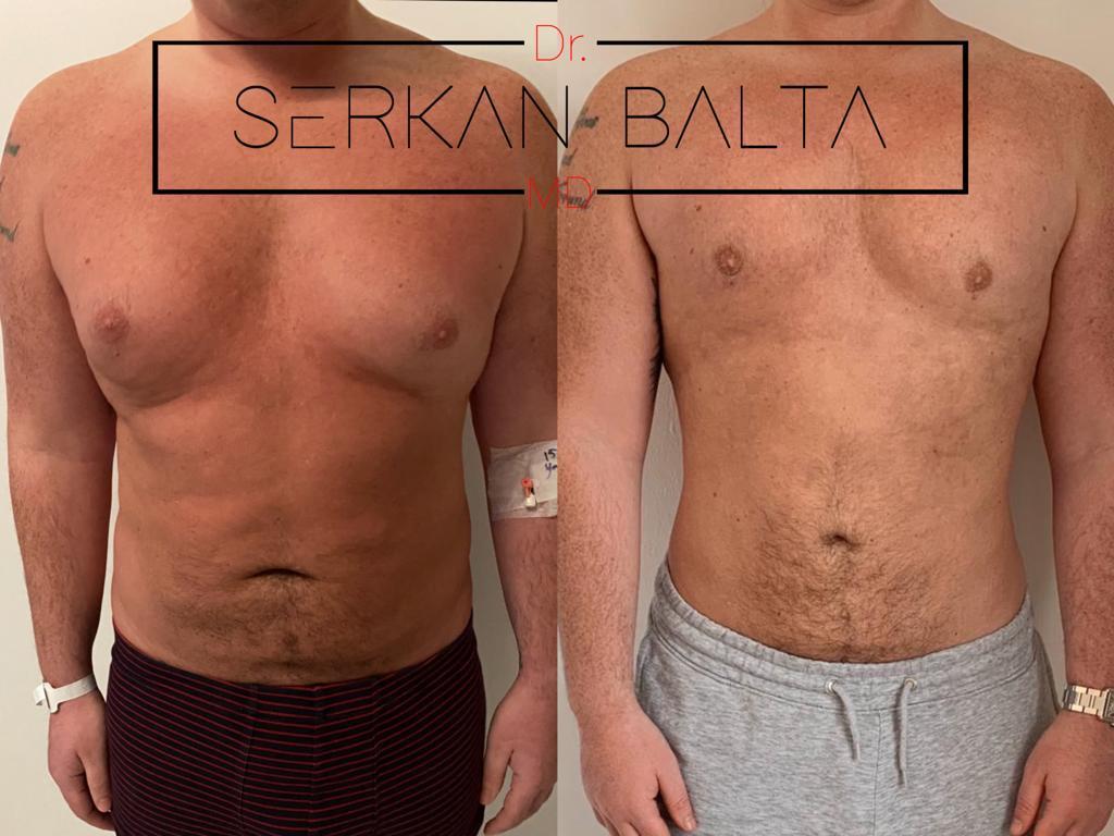 ELIT CLINIC COSMETIC SURGERY RESULTS 4