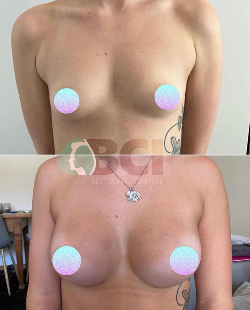 ELIT CLINIC COSMETIC SURGERY RESULTS 19