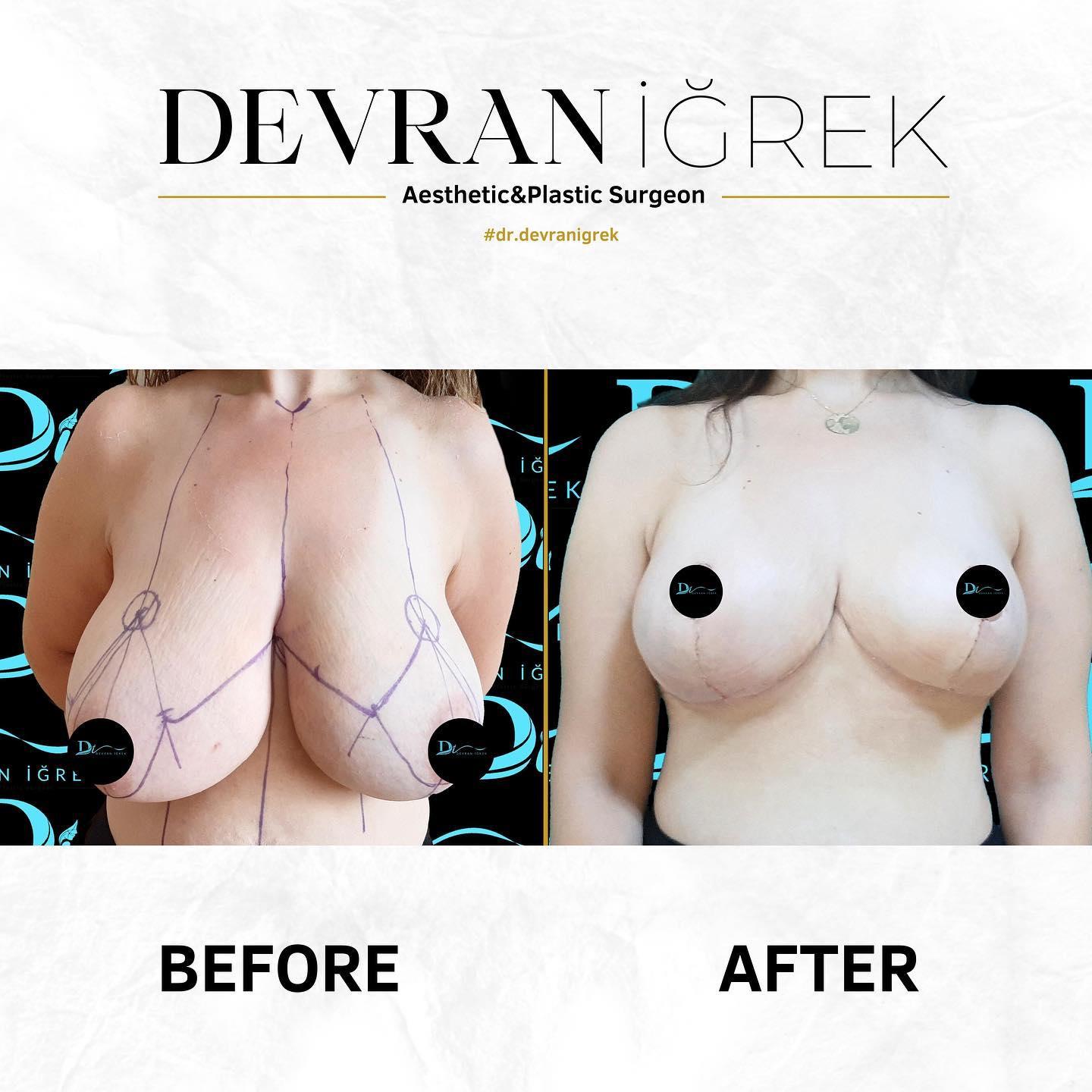 ELIT CLINIC COSMETIC SURGERY RESULTS 11