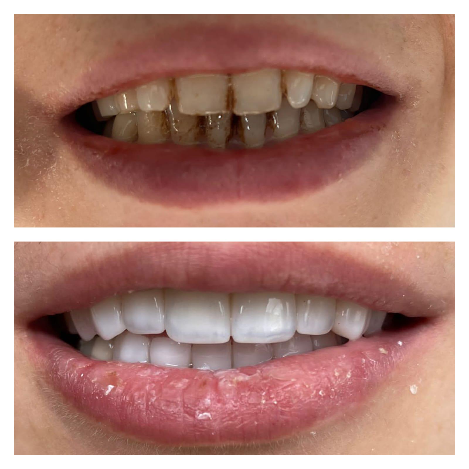 17- Before-after zirkon vaka