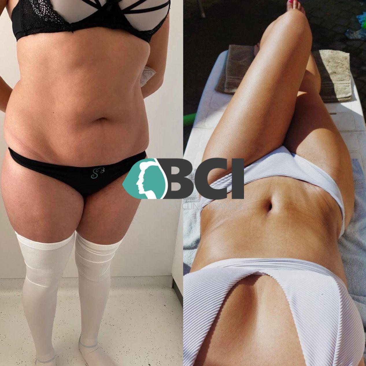 ELIT CLINIC COSMETIC SURGERY RESULTS 18