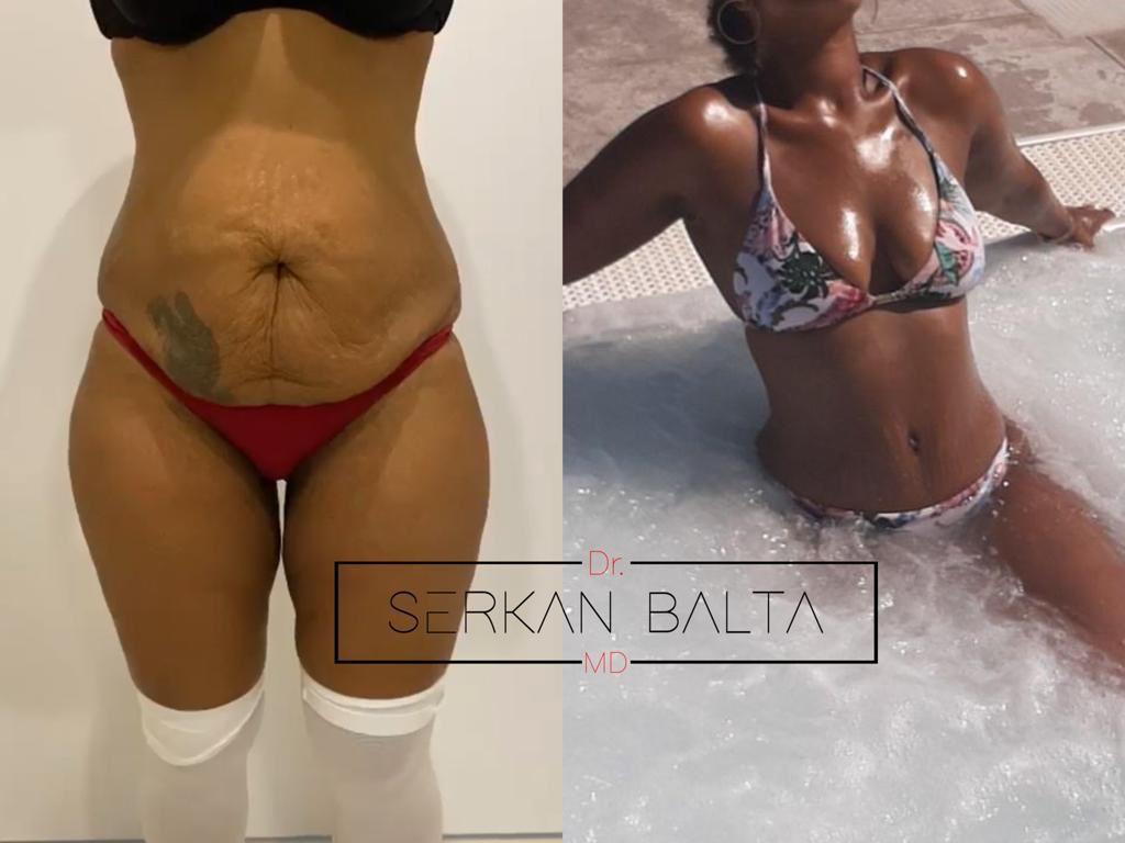 ELIT CLINIC COSMETIC SURGERY RESULTS 17