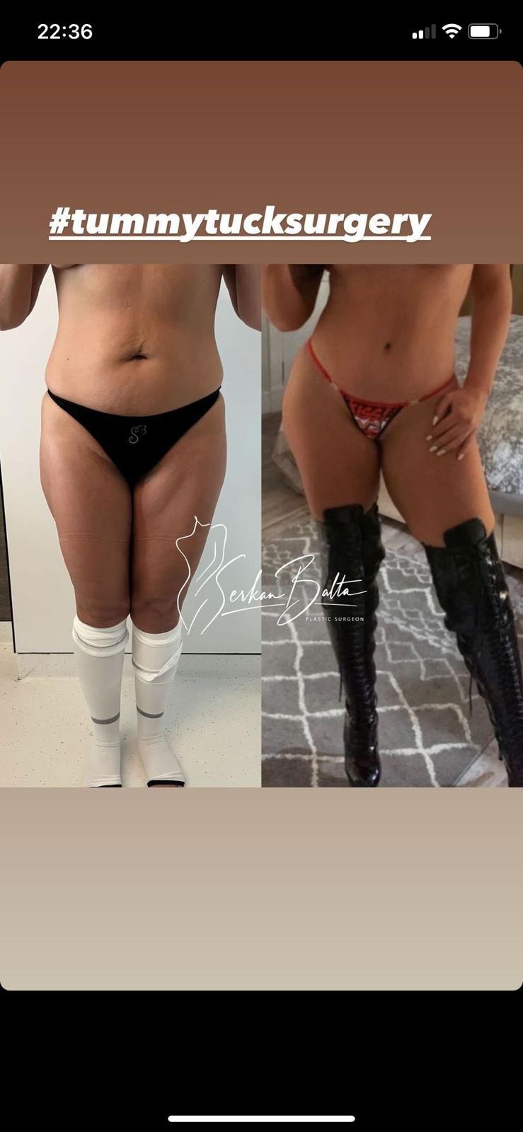 ELIT CLINIC COSMETIC SURGERY RESULTS 14