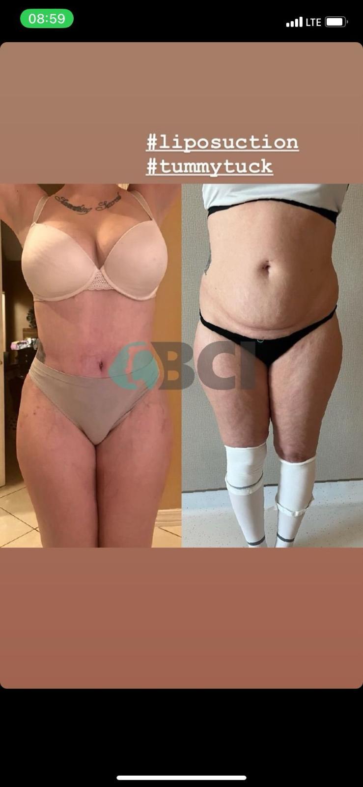 ELIT CLINIC COSMETIC SURGERY RESULTS 15