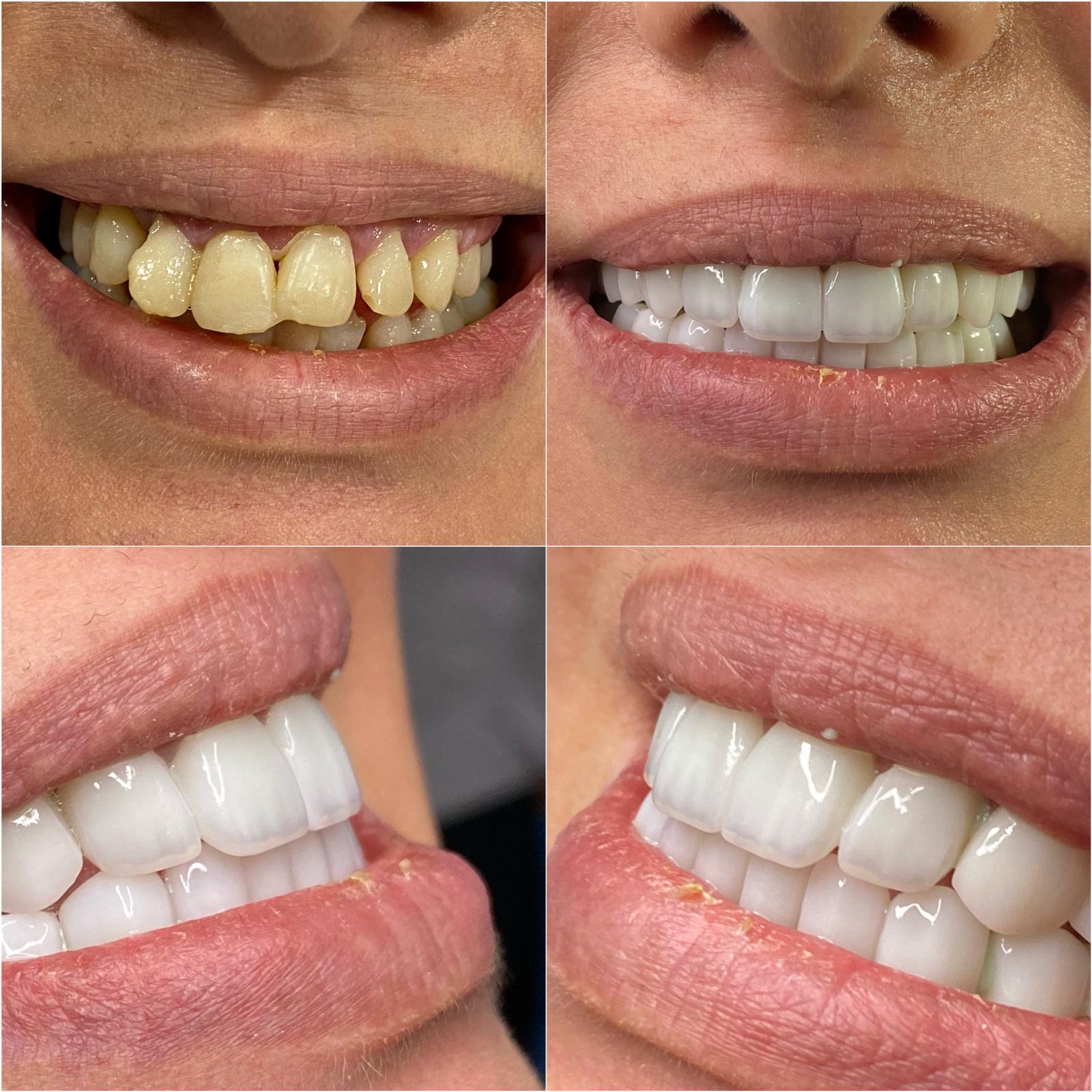 19- Before-after zirkon vaka