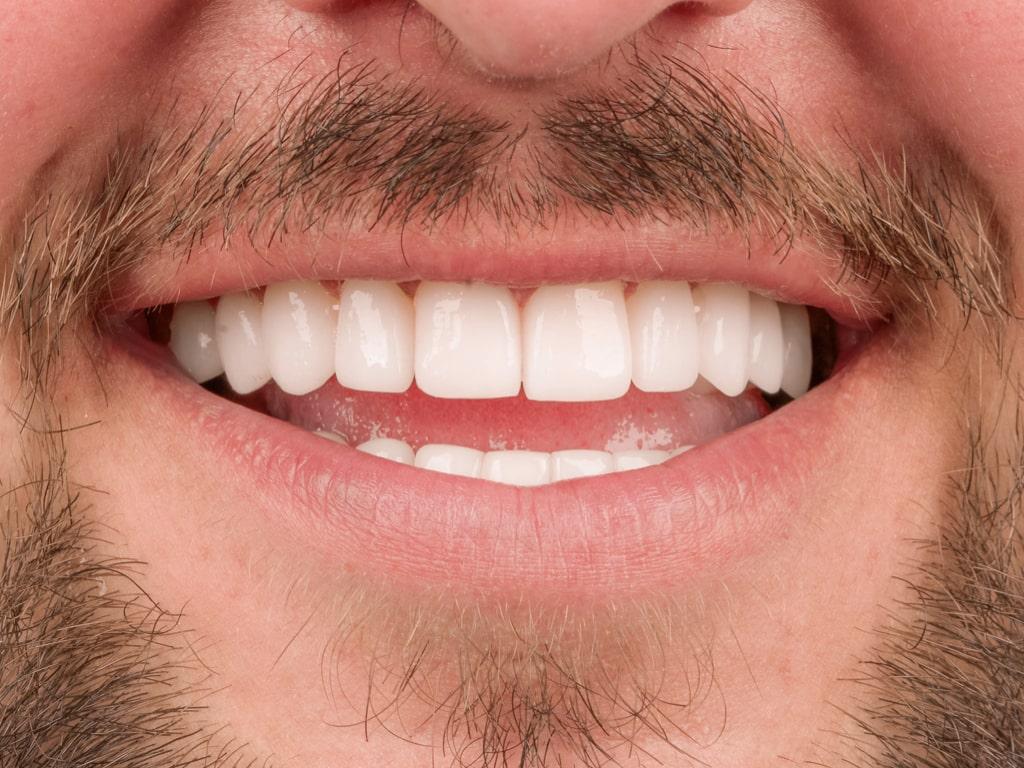 Dental veneers / Facettes Dentaires by VIP Smile 