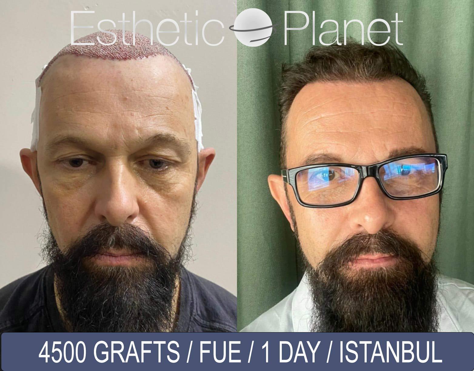 4500-grafts-Hope-hair-Health-