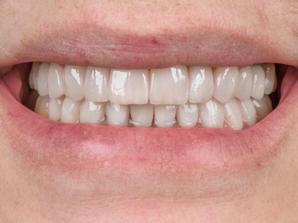 Dental veneers / Facettes Dentaires by VIP Smile 