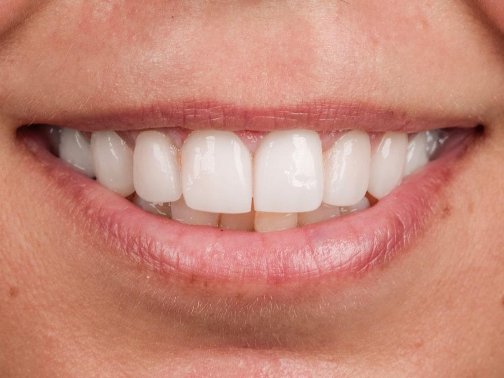 Dental veneers / Facettes Dentaires by VIP Smile 