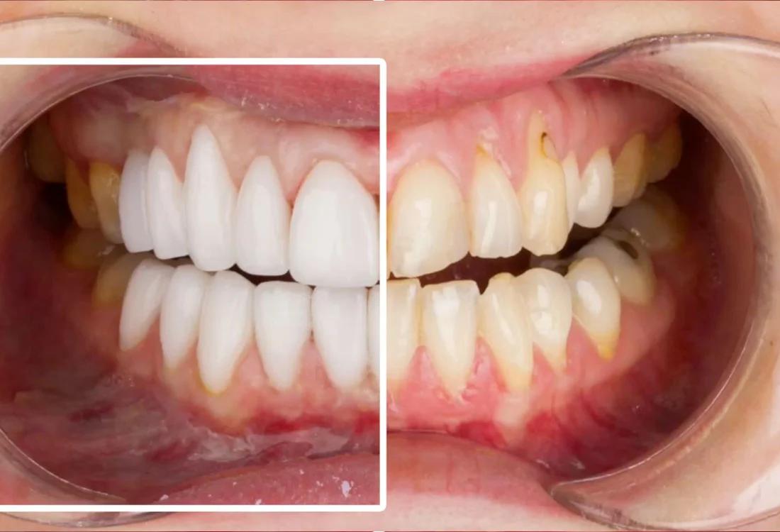 emax veneers results Dentaglobal Turkey