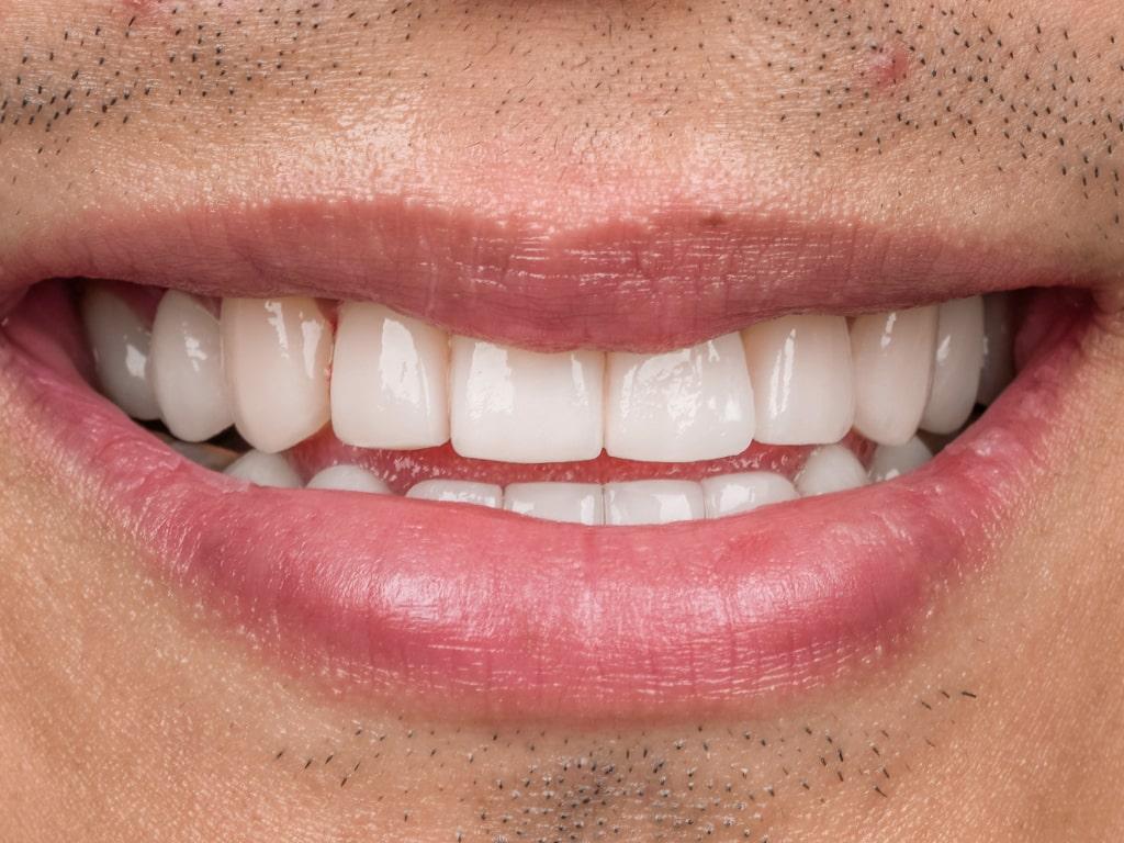 Dental veneers / Facettes Dentaires by VIP Smile 