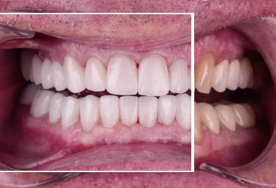 emax veneers results Dentaglobal Turkey
