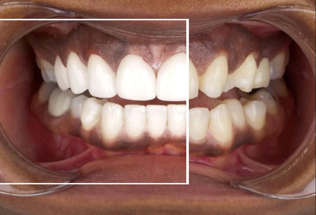 emax veneers results Dentaglobal Turkey
