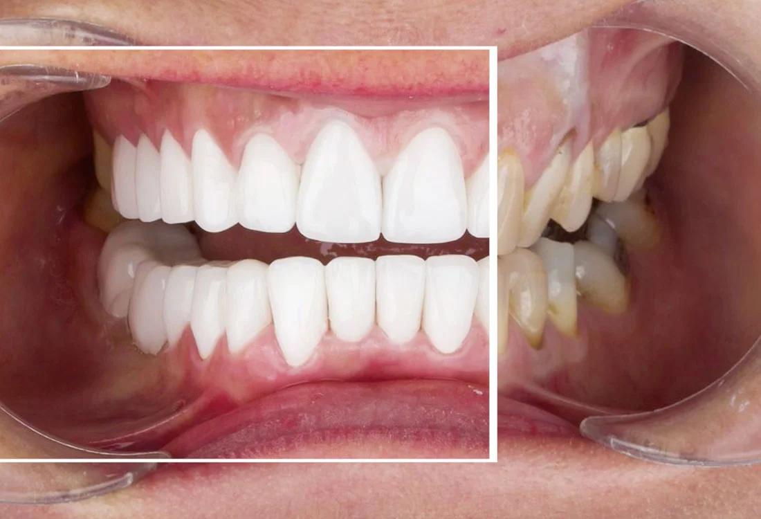 emax veneers results Dentaglobal Turkey