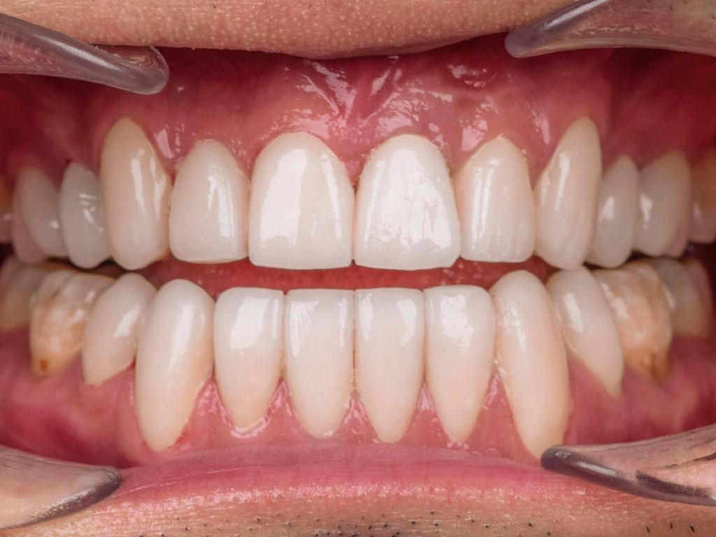 Dental veneers / Facettes Dentaires by VIP Smile 