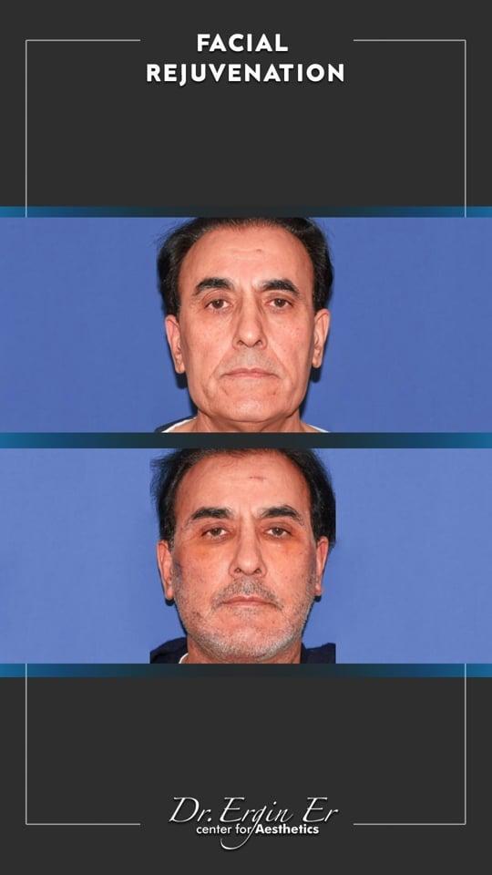 DR ERGIN ER ISTANBUL RESULTS SURGERY 41