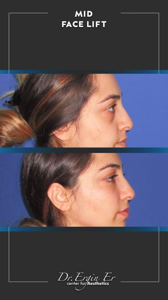 DR ERGIN ER ISTANBUL RESULTS SURGERY 36