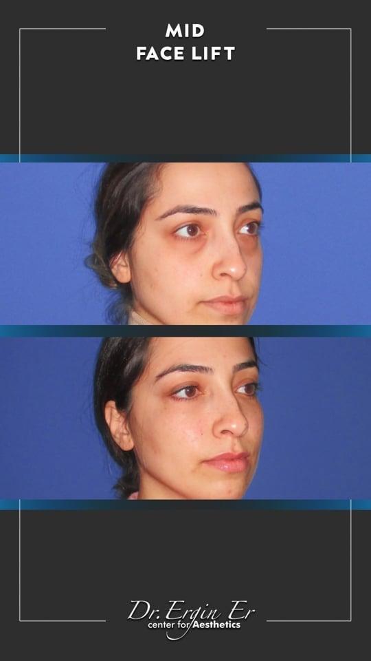 DR ERGIN ER ISTANBUL RESULTS SURGERY 39