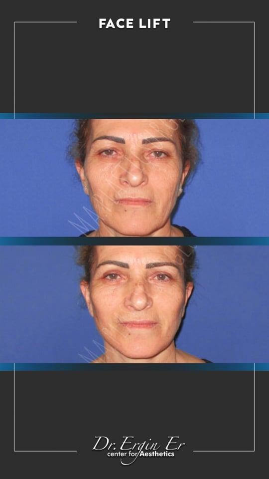 DR ERGIN ER ISTANBUL RESULTS SURGERY 24