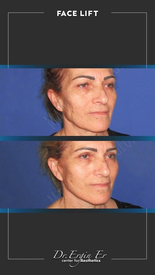 DR ERGIN ER ISTANBUL RESULTS SURGERY 25