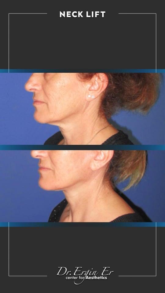 DR ERGIN ER ISTANBUL RESULTS SURGERY 33