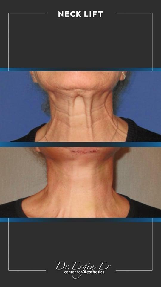 DR ERGIN ER ISTANBUL RESULTS SURGERY 31