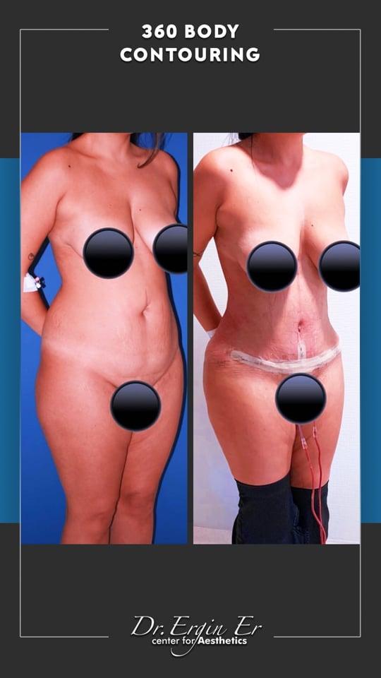 DR ERGIN ER ISTANBUL RESULTS SURGERY 40