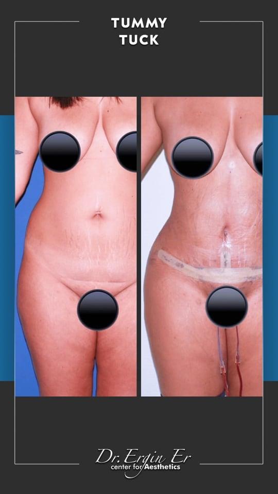 DR ERGIN ER ISTANBUL RESULTS SURGERY 38