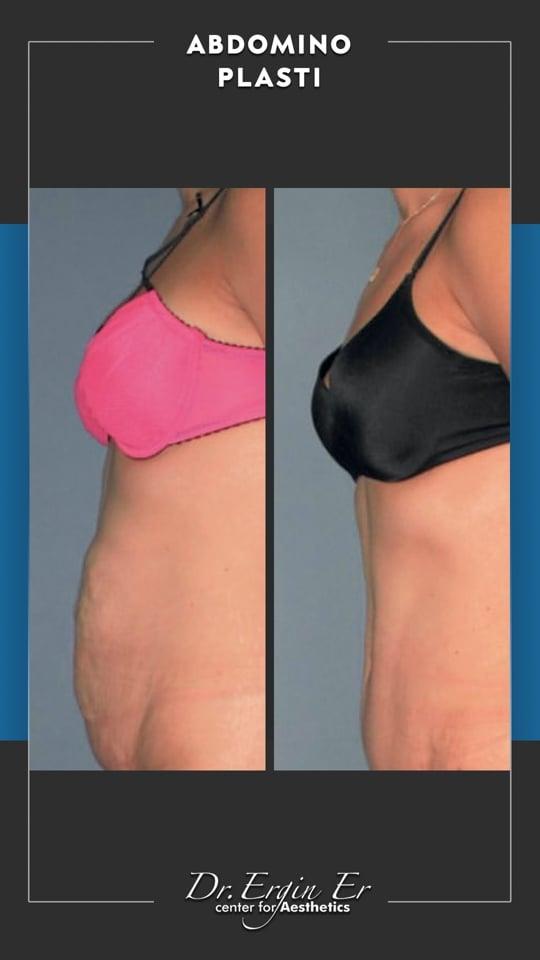 DR ERGIN ER ISTANBUL RESULTS SURGERY 23