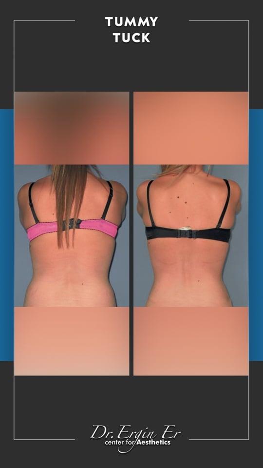 DR ERGIN ER ISTANBUL RESULTS SURGERY 12