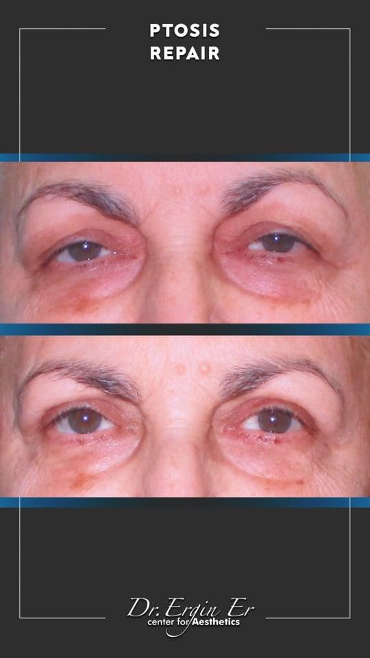 DR ERGIN ER ISTANBUL RESULTS SURGERY 14